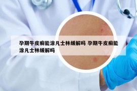 孕期牛皮癣能涂凡士林缓解吗 孕期牛皮癣能涂凡士林缓解吗