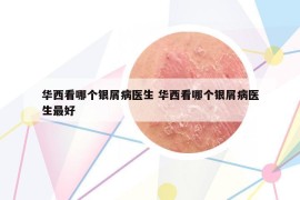 华西看哪个银屑病医生 华西看哪个银屑病医生最好