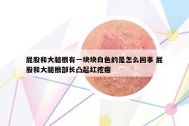 屁股和大腿根有一块块白色的是怎么回事 屁股和大腿根部长凸起红疙瘩