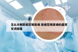 怎么诊断脓疱型银屑病 脓疱型银屑病的最常见诱因是