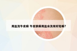 用盐洗牛皮癣 牛皮肤癣用盐水洗有好处嘛?