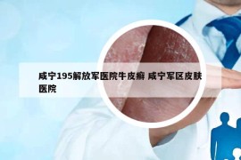咸宁195解放军医院牛皮癣 咸宁军区皮肤医院
