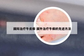 国际治疗牛皮癣 国外治疗牛癣的先进方法