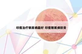 印度治疗银屑病最好 印度银屑病软膏