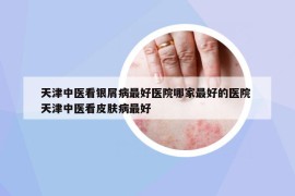 天津中医看银屑病最好医院哪家最好的医院 天津中医看皮肤病最好