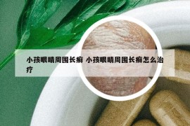小孩眼睛周围长癣 小孩眼睛周围长癣怎么治疗