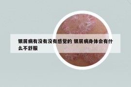 银屑病有没有没有感觉的 银屑病身体会有什么不舒服