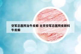 空军总医院治牛皮癣 北京空军总医院皮肤科牛皮癣