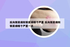 反向银屑病和银屑病哪个严重 反向银屑病和银屑病哪个严重一点
