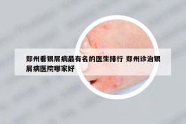 郑州看银屑病最有名的医生排行 郑州诊治银屑病医院哪家好