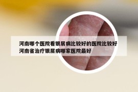 河南哪个医院看银屑病比较好的医院比较好 河南省治疗银屑病哪家医院最好