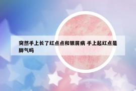 突然手上长了红点点和银屑病 手上起红点是脚气吗
