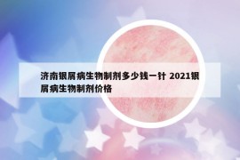 济南银屑病生物制剂多少钱一针 2021银屑病生物制剂价格