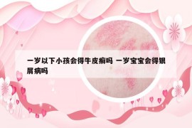一岁以下小孩会得牛皮癣吗 一岁宝宝会得银屑病吗