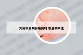 外阴银屑病会癌变吗 银屑病阴道