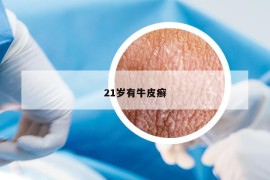 21岁有牛皮癣