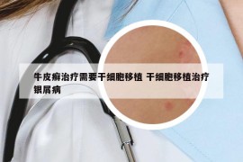 牛皮癣治疗需要干细胞移植 干细胞移植治疗银屑病