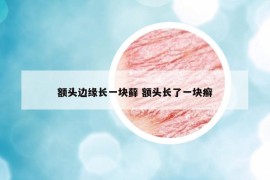 额头边缘长一块藓 额头长了一块癣