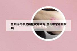 兰州治疗牛皮癣医院哪家好 兰州哪家看银屑病