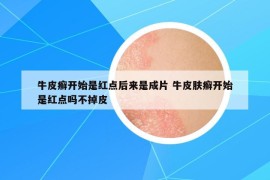 牛皮癣开始是红点后来是成片 牛皮肤癣开始是红点吗不掉皮