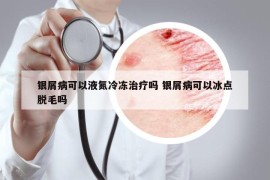 银屑病可以液氮冷冻治疗吗 银屑病可以冰点脱毛吗
