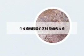 牛皮癣和股藓的区别 股癣和皮癣
