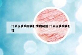 什么皮肤病需要打生物制剂 什么皮肤病要打针