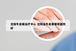沈阳牛皮癣治疗中心 沈阳治牛皮屑哪家医院好