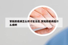 掌跖脓疱病怎么样才能治愈 掌跖脓疱病是什么病啊