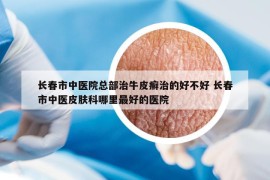 长春市中医院总部治牛皮癣治的好不好 长春市中医皮肤科哪里最好的医院