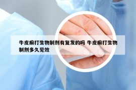 牛皮癣打生物制剂有复发的吗 牛皮癣打生物制剂多久见效