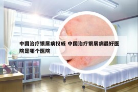 中国治疗银屑病权威 中国治疗银屑病最好医院是哪个医院