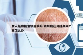 女人经血能治银屑病吗 银屑病在月经期间严重怎么办