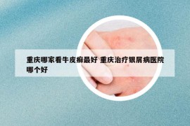 重庆哪家看牛皮癣最好 重庆治疗银屑病医院哪个好