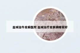 盐城治牛皮癣医院 盐城治疗皮肤病哪家好