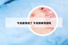 牛皮癣发烧了 牛皮肤癣发烧吗