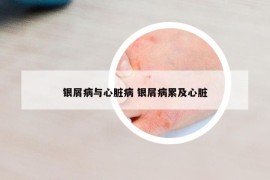 银屑病与心脏病 银屑病累及心脏