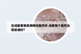 在成都看银屑病哪所医院好 成都哪个医院治银屑病好?