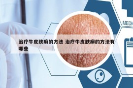 治疗牛皮肤癣的方法 治疗牛皮肤癣的方法有哪些