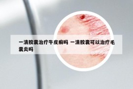 一清胶囊治疗牛皮癣吗 一清胶囊可以治疗毛囊炎吗