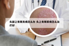 头部上有银肖病怎么办 头上有银屑病怎么治疗好