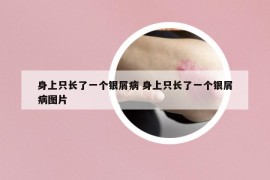 身上只长了一个银屑病 身上只长了一个银屑病图片