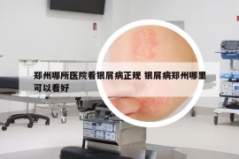 郑州哪所医院看银屑病正规 银屑病郑州哪里可以看好