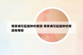 银屑病引起腿肿的原因 银屑病引起腿肿的原因有哪些
