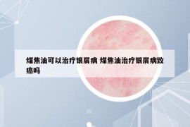 煤焦油可以治疗银屑病 煤焦油治疗银屑病致癌吗