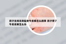 孩子无缘无故起些牛皮癣怎么回事 孩子得了牛皮皮癣怎么办