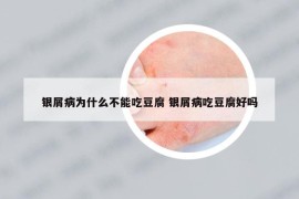 银屑病为什么不能吃豆腐 银屑病吃豆腐好吗