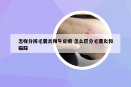 怎样分辨毛囊炎和牛皮癣 怎么区分毛囊炎和猫藓