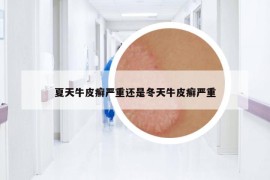 夏天牛皮癣严重还是冬天牛皮癣严重