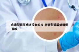 点滴型银屑病还没有蜕皮 点滴型银屑病消退 掉皮